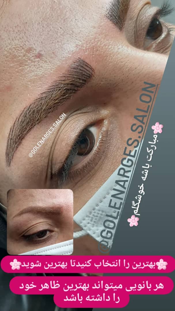 کاشت مژه و ابرو